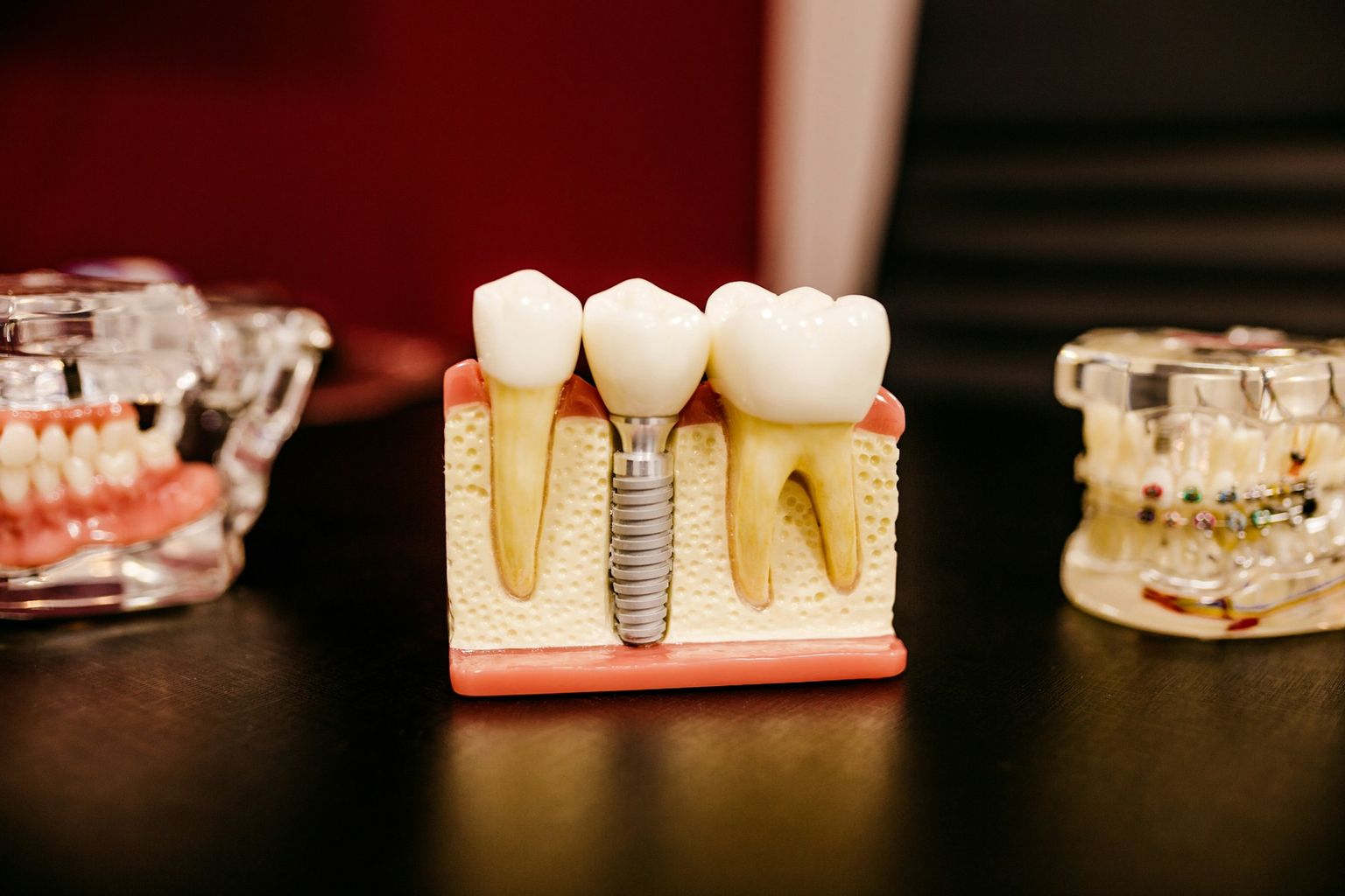 A cutaway model of a dental implant beside natural teeth