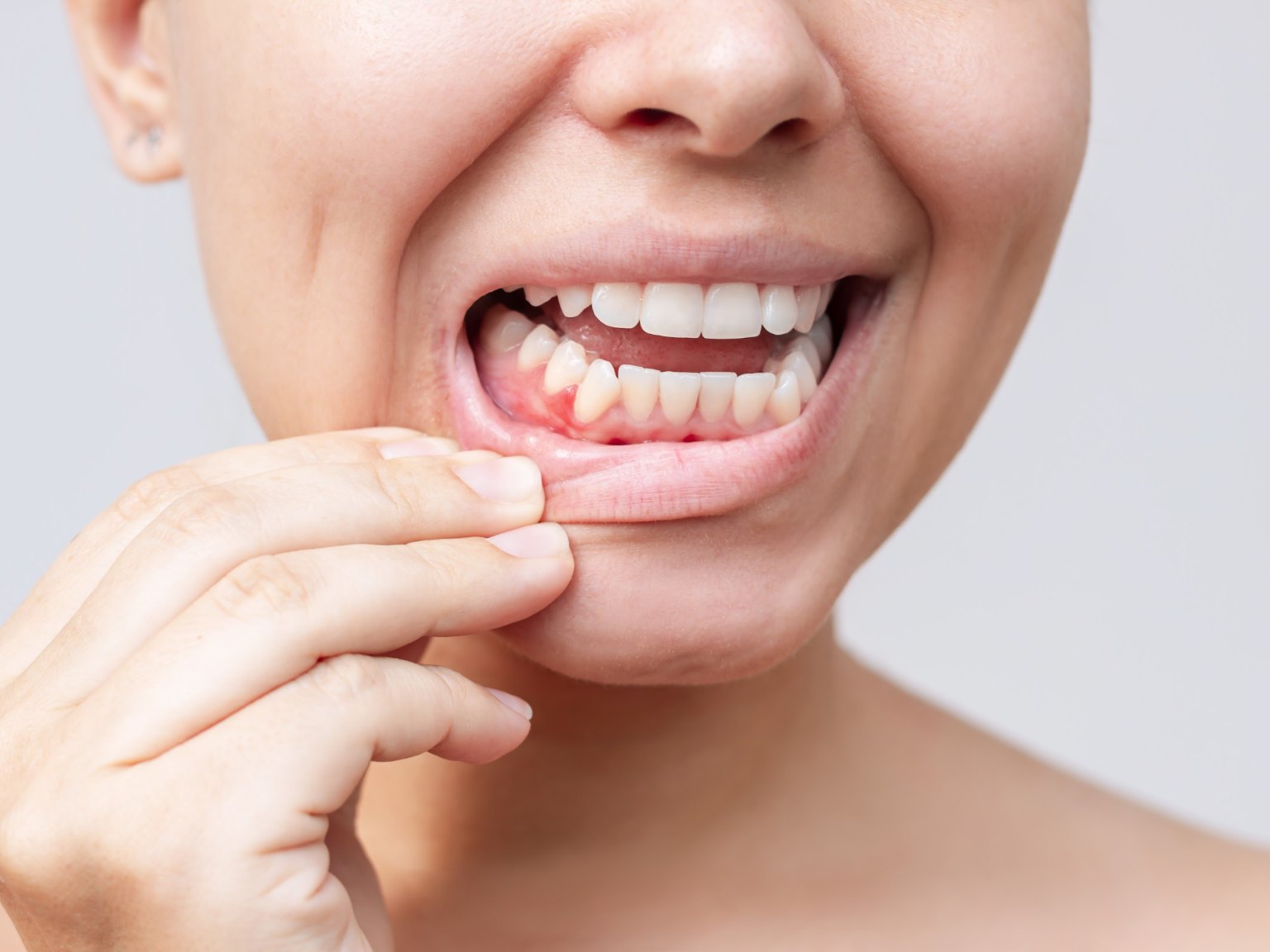 A woman pulling down her lip to show sore, bleeding gum at the base of a lower tooth
