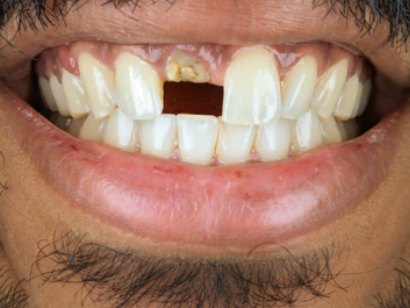 A smile with a missing upper front tooth, a broken root visible in the gap