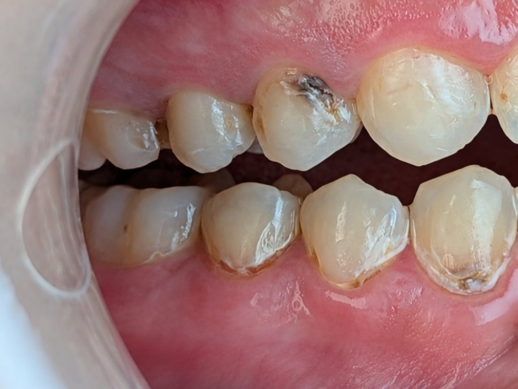 A close-up of teeth with one darkened tooth and brown staining at the gumline