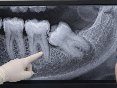 An x-ray of a wisdom tooth lying sideways against the molar in front of it, a gloved finger pointing