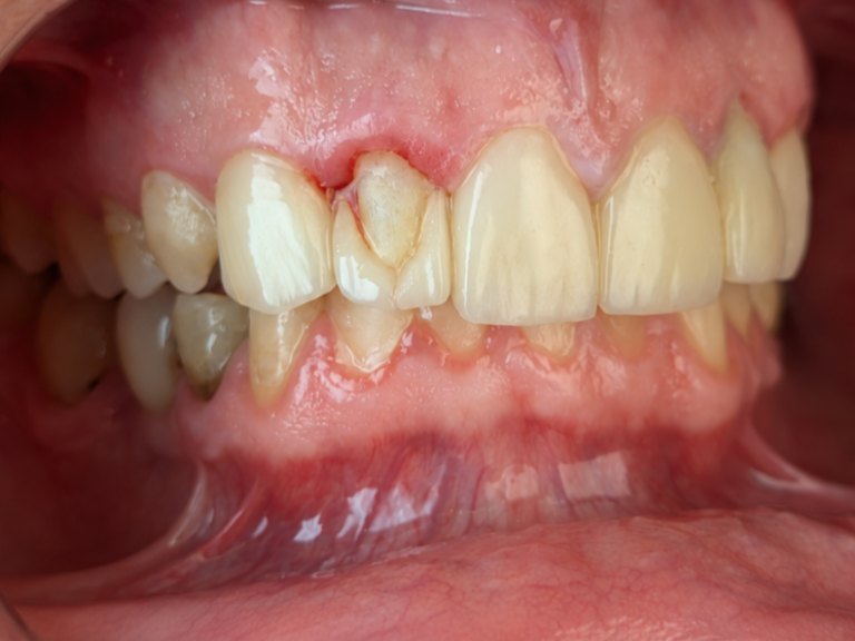 A close-up of a broken front tooth with a chipped edge beside the healthy teeth