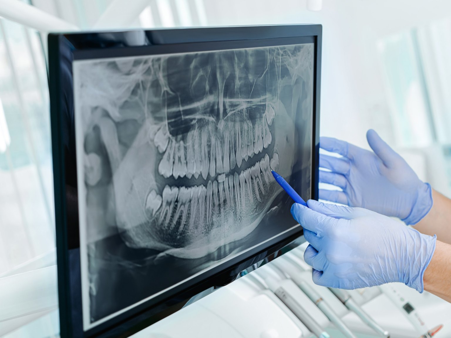 Gloved hands pointing a pen at a panoramic x-ray of a full set of teeth on a monitor