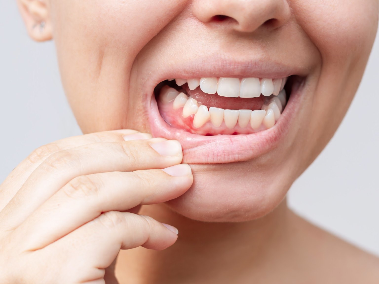 A lower lip pulled down to show a red, swollen spot on the gum beside a tooth
