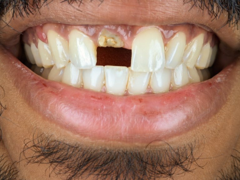 A man's smile with an upper front tooth missing, leaving a dark gap