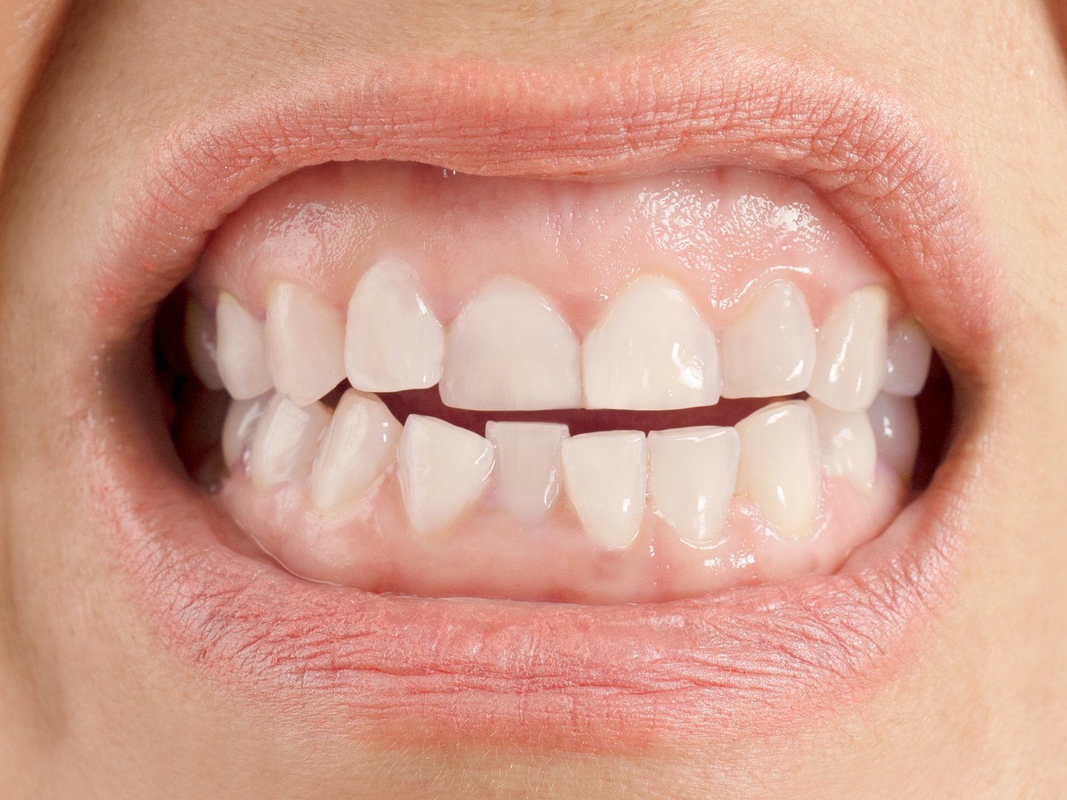 A woman's smile showing a wide band of gum above short upper teeth