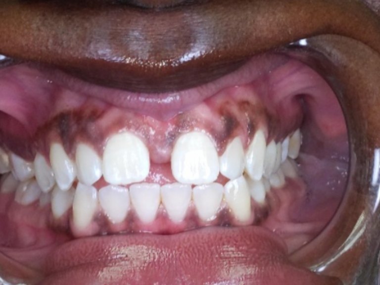 Close-up of an open mouth showing a gap between the front teeth and darkened gums