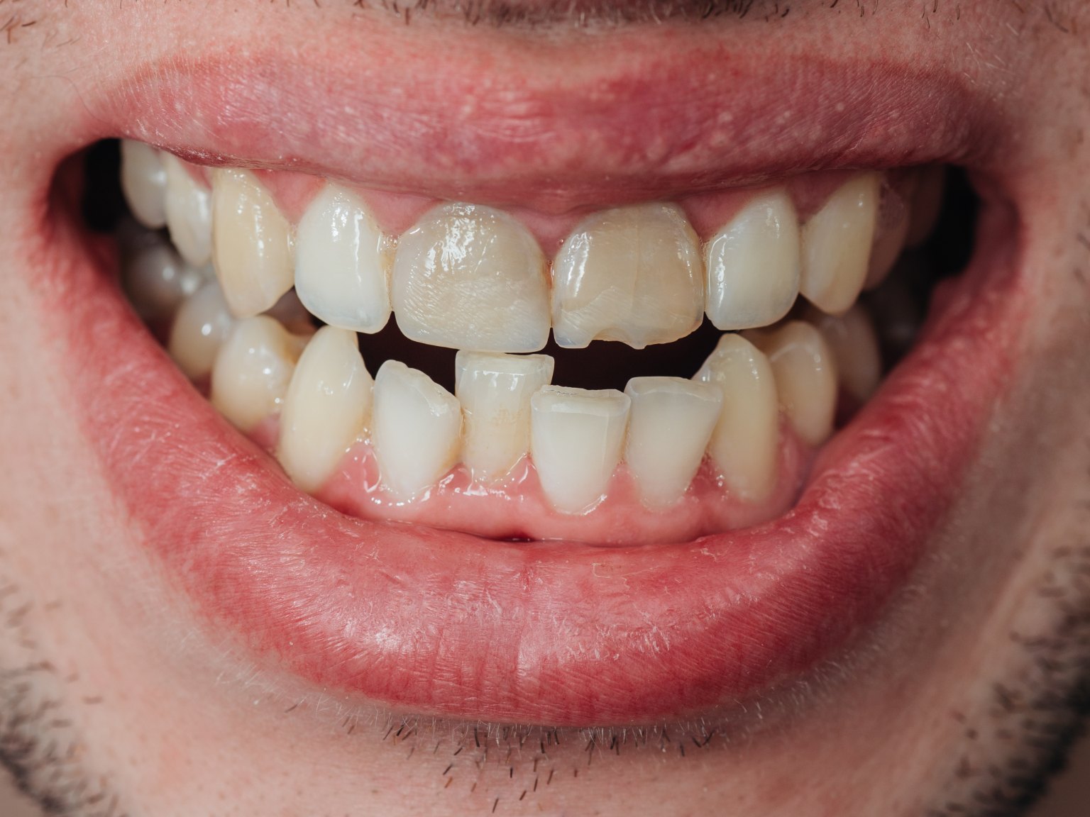 Close-up of front teeth with chipped, worn and uneven biting edges