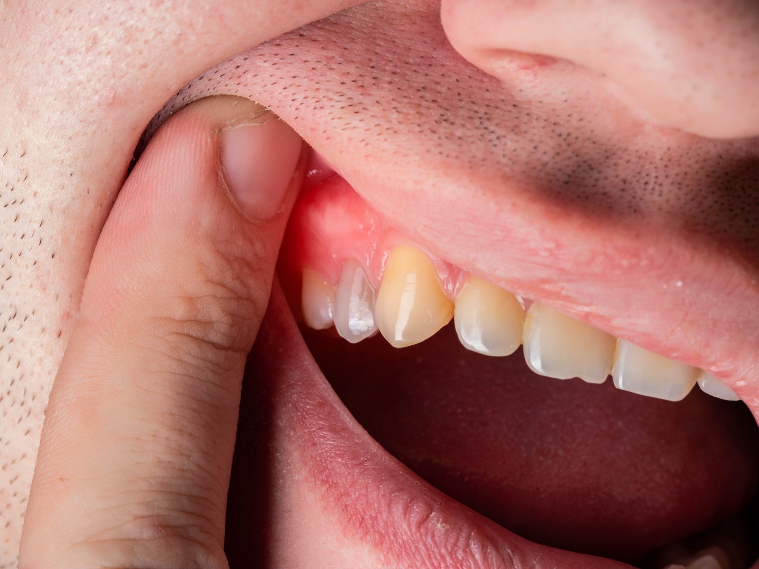 A man lifting his upper lip to show a red, swollen patch of gum above his front teeth