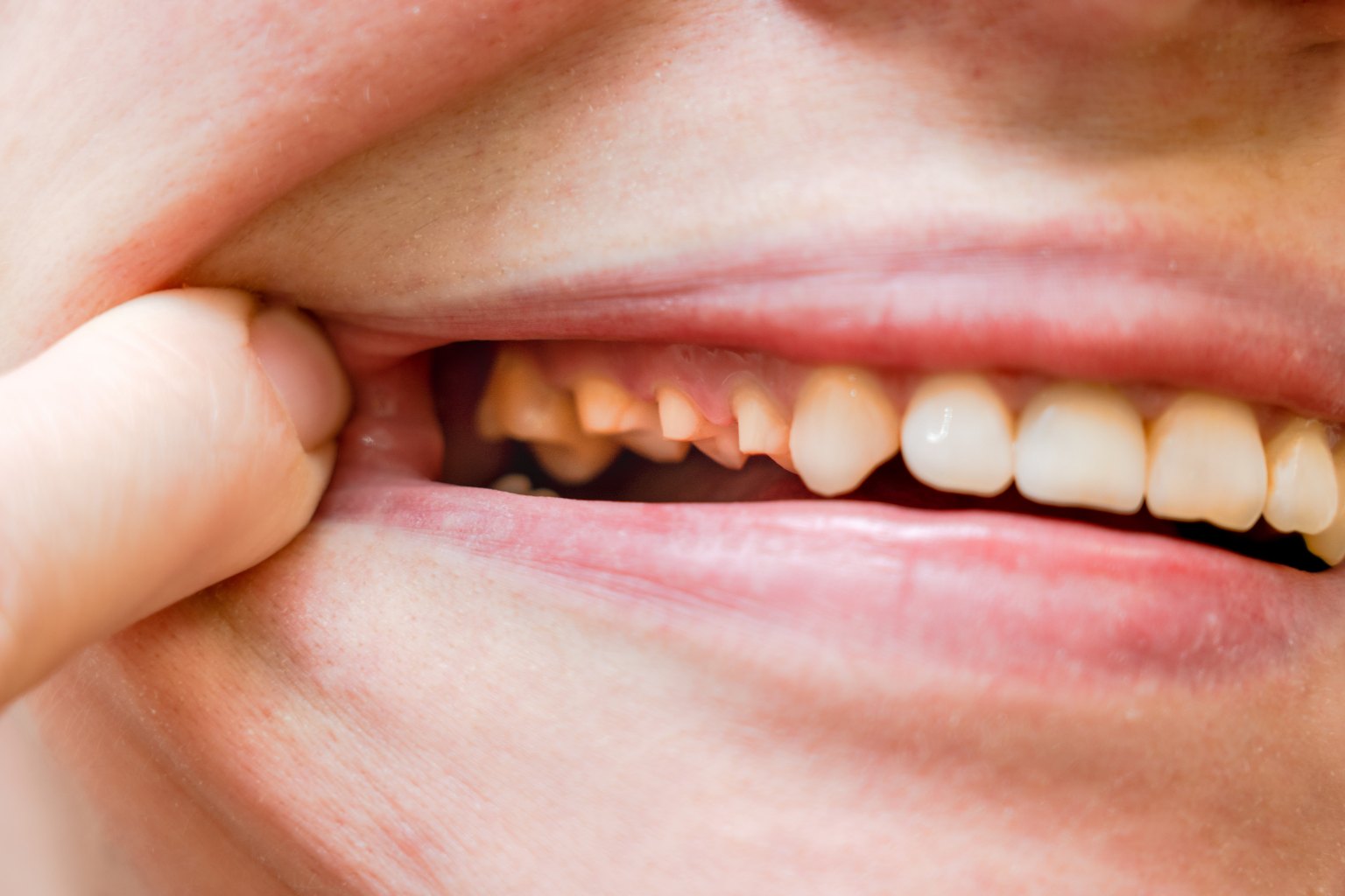 Close-up of teeth worn down and broken at the edges