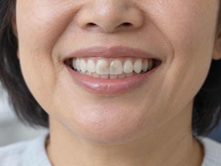 A close-up smile with brown staining on the front teeth