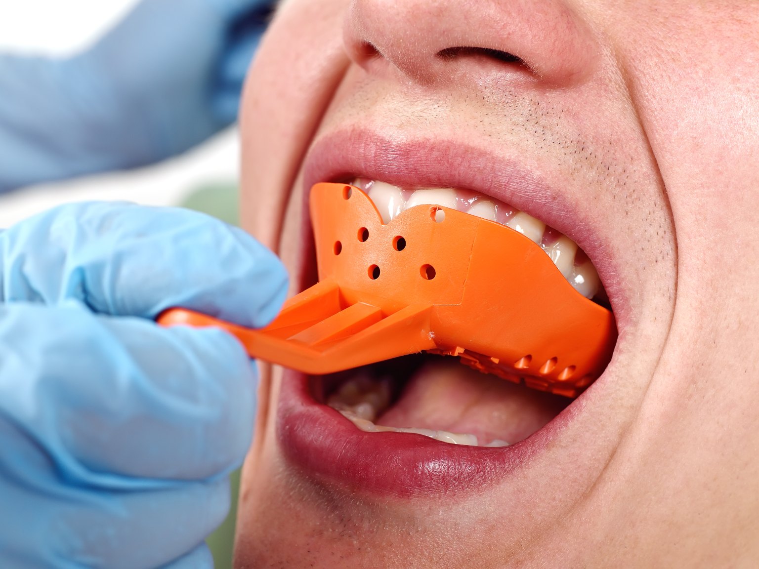 A gloved hand pressing an orange impression tray into a patient's mouth